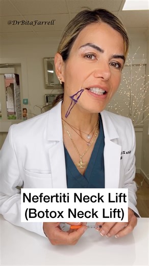 The Nefertiti neck lift. Strategic Botox along the platysma and DAO relaxes the downward pull on the jawline and lower face, allowing the cheek muscles that lift the face to dominate. Result: a sharper jawline, softer neck bands, and a subtle lower face lift. #necklift #botoxnecklift #nefertitinecklift #naturalaestheticscenter #drbitafarrell