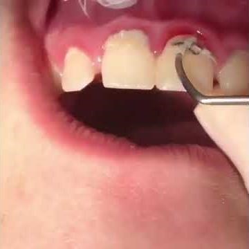 Cleaning Dental Calculus with Hand Scaler