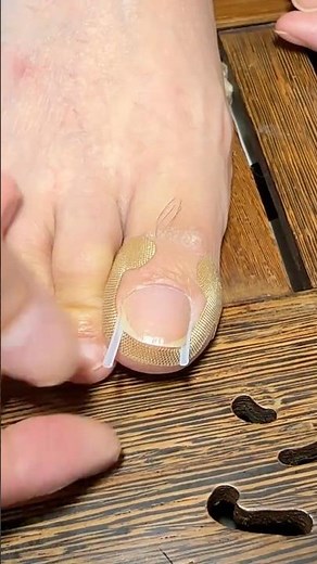 Time to Show the Real Technique—Ingrown Nail Solution! 🔥