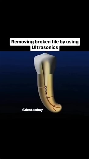 Dent Academy on Instagram: "How to remove a broken file in tooth canal by using ultrasonics 🦷👀 Have you ever used ultrasonics? 🤔 Was it efficient?"