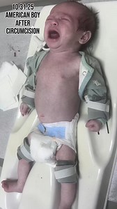 HOW TO CIRCUMCISE A BABY IN TEN STEPS. 1. Doctor removes the baby's diaper. 2. Doctor shoves a long rod called a "circumcision probe" into the penis opening and rips the foreskin loose from the head of the penis. If you listen carefully you can hear the ripping of the delicate membrane that connects the inner lining of the foreskin to the surface of the glans. This initial stage of the circumcision is the most excruciating torture known to a human being, comparable to ripping off the baby's fing