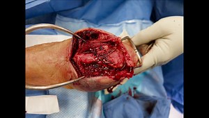 Wide Awake Hand Surgery: Olecranon Fracture Suture Repair