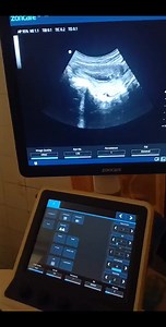 64K views · 481 reactions | https://www.facebook.com/profile.php?id=61566377910659 . | Ultrasound learnig and knowledge sharing | Facebook
