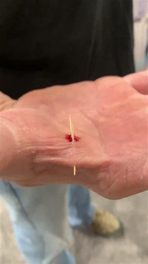 GIANT WOOD SPLINTER THROUGH THE HAND #shorts #shortvideo #work #accident #diy #trendingshorts #wow