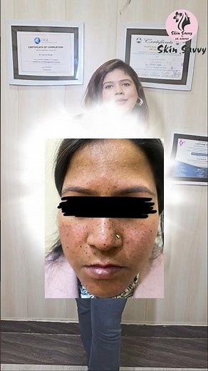 Freckles removal through laser #freckles #skincare #dermatologist