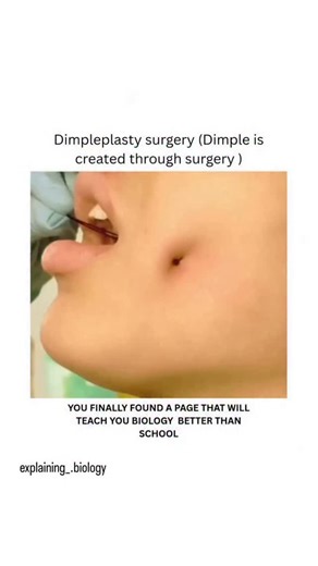 explaining. biology on Instagram: "Dimpleplasty is a minimally invasive cosmetic procedure performed to create natural-appearing dimples on the cheeks or chin. The procedure involves making a small incision inside the mouth and placing a suture to connect the skin to the underlying muscle. It is typically a quick procedure, performed under local anesthesia, with minimal downtime. Most individuals can resume normal activities within a few days, although mild swelling may occur temporarily. For ed