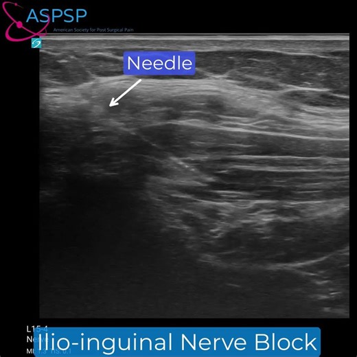 Ultrasound Guided Ilio-inguinal Nerve Block for Post Herniorrhaphy Pain