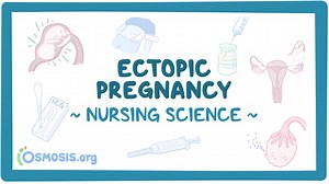 Ectopic pregnancy: Nursing: Video & Causes | Osmosis