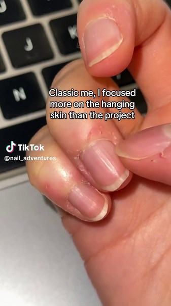Nail Skin Picking: A Stressful Habit Unveiled