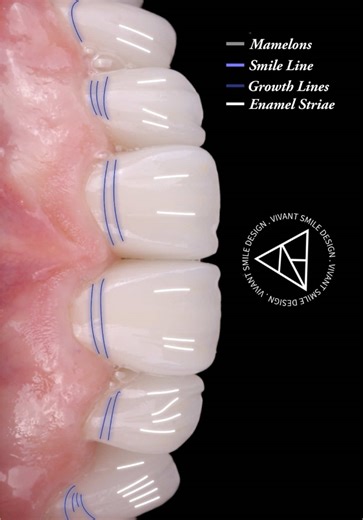 ✨ Transforming Smiles, Changing Lives ✨ At Vivant Smile Design, we specialize in restoring the functionality, aesthetics, and confidence of your smile. 🌟 📹 In this reel, we showcase the before and after of a full dental rehabilitation with crowns. Every detail is crafted to give you a smile that looks as natural as it is stunning. 🦷💎 🔹 What are dental crowns? Custom-made restorations that repair damaged or weakened teeth, restoring their strength and appearance. Perfect for transforming you