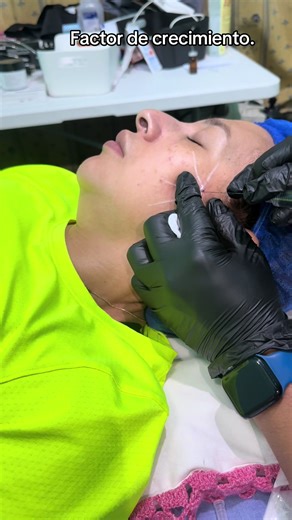 Aplicación de factor de crecimiento. GFC-6 y Bioestimulador de colágeno. #bioestimuladordecolageno #lifting @Vanessa Cano #LIVEIncentiveProgram #LIVEwithlowfollowers #PaidPartnership
