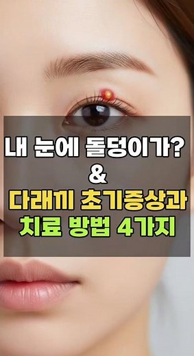 내 눈에 돌덩이가? 다래끼 24시간 안에 치료하는 방법 #다래끼 #50대건강 #40대건강 #건강한중년