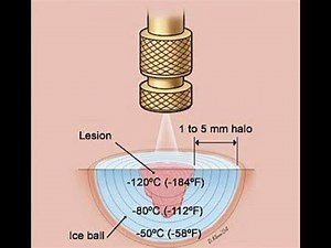 Cryotherapy or Cryoablation or Cryosurgery or Cold therapy ; Overview, Indications, Types, Uses,