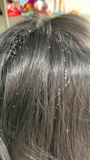 Effective Lice Removal Techniques for Parents