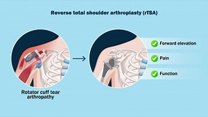 What is the ideal version for the humeral component in reverse #shoulderarthroplasty? Neutral? Retroversion? This is studied in a recent jbjs article. What do our #shoulder experts think? #shoulderelbow https://bit.ly/4crhezh | The Journal of Bone & Joint Surgery (JBJS)