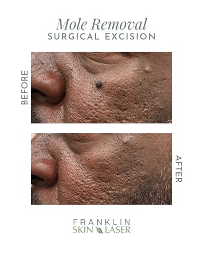 This stunning transformation was achieved by Dr. B, who used precise surgical techniques to remove the unwanted mole with minimal scarring and beautiful, natural-looking results. 💫 Whether for cosmetic enhancement or medical reasons, Dr. B’s meticulous technique ensures safe, effective mole removal while preserving your skin’s natural texture and tone! Book your mole removal consultation today! 📞: 615.595.8177 💬: 866.972.1635 #franklinskinandlaser #medspa #aesthetics #skin #skincare #franklin