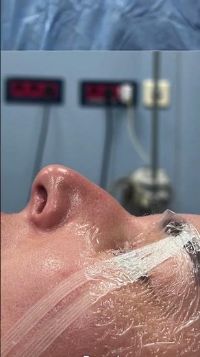 Rhinoplasty: Before vs Immediately After Surgery