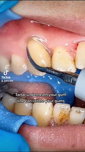 13K views · 69 reactions | Removal of tartar build up through dental...