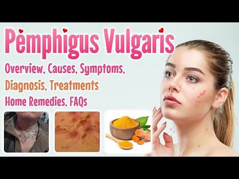 Pemphigus Vulgaris overview, causes, sign and symptoms, diagnosis, treatment, home remedies and FAQs