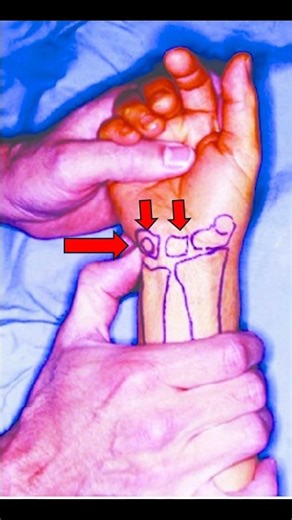 🖐️ Lunotriquetral Compression Test | Wrist Pain Exam #meded #ortho #physio #ATC #medicaleducation