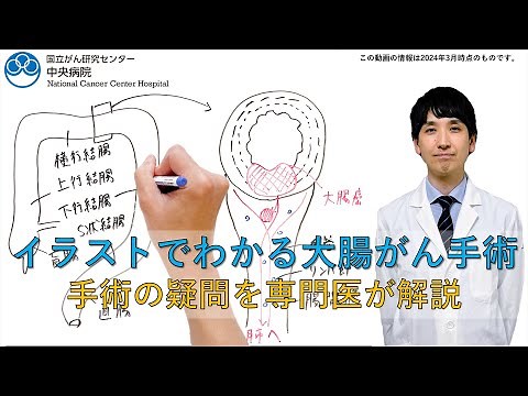 専門医が教える大腸がん手術～イラストで分かりやすく解説～【国立がん研究センター 中央病院】