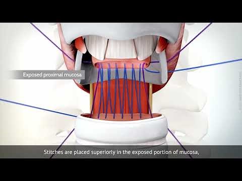 Cricotracheal resection for subglottic tracheal stenosis