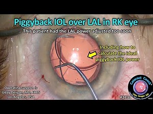 CataractCoach™ 2731: piggyback IOL over Light Adjustable Lens (LAL) in radial keratotomy RK eye