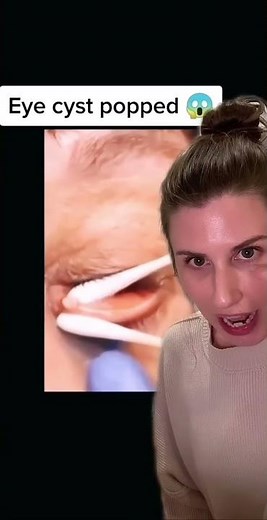 Eyelid Cyst Pop! Cyst of Zeis or Meibomian Cyst?!