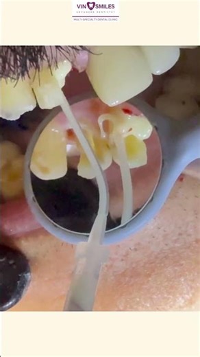 Core Build Up Explained in 30 Seconds!