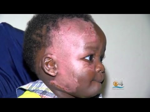 Mother Says Daycare Lied, Called Baby’s Burns A ‘Fever’