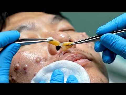 Giant Ear Blackhead Extraction | Dr. Pimple Popper’s Most Satisfying Transformation, #broken mirrors
