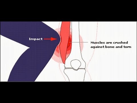 Fisioterapia Elizabeth Ayamonte - CONTUSIONES MUSCULARES