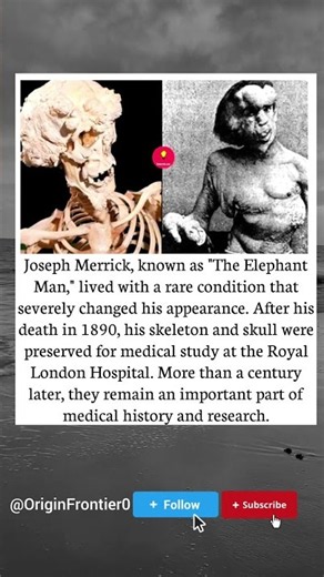 The Man Called "Elephant Man". His Story Will Break You