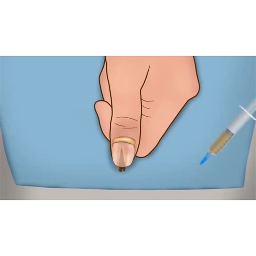 Explaning BioMedical | "Thumb infection? Learn how to spot and treat it in seconds! 🚨💡" . .. . . . . .. #ThumbInfection #HealthTips #InfectionPrevention... | Instagram