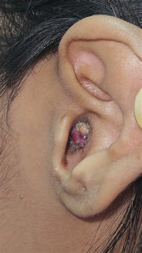 granulation #infections #chronic #ear polyp #knowledge #drbaisalisarkar #ent #doctor #kolkata