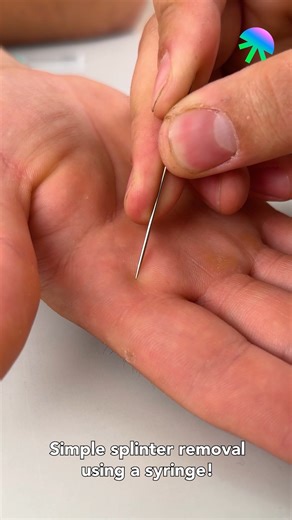Simple splinter removal using a syringe! | Cuff-Zoned