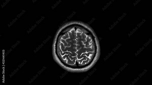 Magnetic Resonance Imaging (MRI) of the Human Brain, 3Tesla sagittal T2 weighted sequences real scan