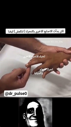 🧠 علامة هوفمان – Hoffman Sign #طب #ترند #اكسبلور #viral