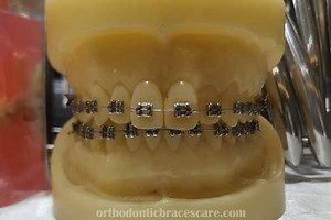 10 Reasons Why Your Teeth Turn Yellow With Braces - Orthodontic Braces Care