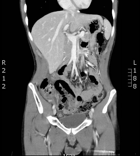 Appendicitis Coronal, CT. JETem 2017.