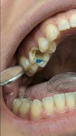 From Old Filling to Perfect Tooth | Satisfying Repair #asmr #satisfying #dental