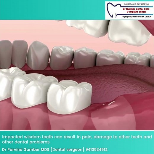 wisdom Tooth Pain #wisdomtoothextraction #wisdomtooth #wisdomtoothremoval #dentalpain