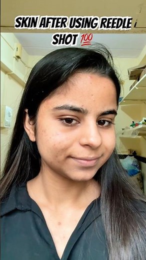 My skin after using VT Cosmetics Reedle Shot 100 | Day 1 review | Needle 💉 Shot for face |