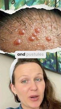 Demodex Mites and Hair Loss #demodexmites #hairloss #scalphealth #demodex #alopecia #goingbald