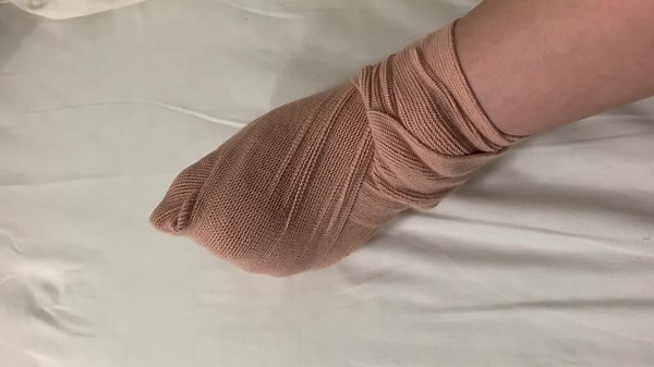 Post-Surgery Recovery Insights on Foot Rehabilitation