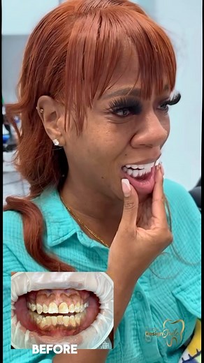 Discover the story of our patient who sheds tears of happiness! Her smile means so much to her that we decided to give her a brilliant Hollywood smile. ✨殺 Are you ready to be a part of our transformation stories? Join our dental family and discover how a smile can change lives. We welcome you with open arms and a radiant smile.♥️ | Dental Design Smile | Facebook
