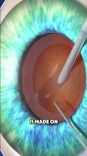 Cloudy Vision? Here’s the Fix! (3D) #cataractsurgery #eyesurgery #visionhealth #ophthalmology