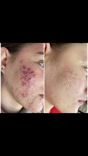 #beforeandafter #skincare #satisfying #skicareroutine #vivace #perfectcleaning #dermapentreatment #cleaning