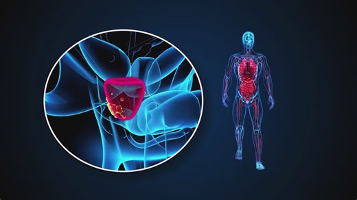 Urologist speaks on rising cases of advanced prostate cancer