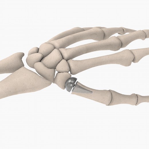 CMC Joint Replacement - The BioPro Modular Thumb Implant